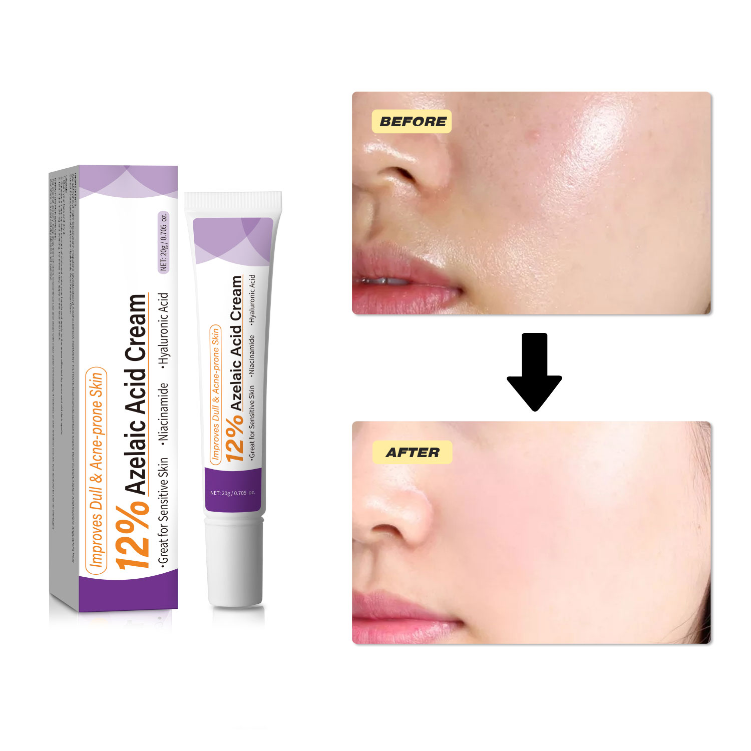 ครีมกรดอะซีเลอิกสูตรอ่อนโยน ช่ - Azelaic Acid Serum บทวิจารณ์และราคา
